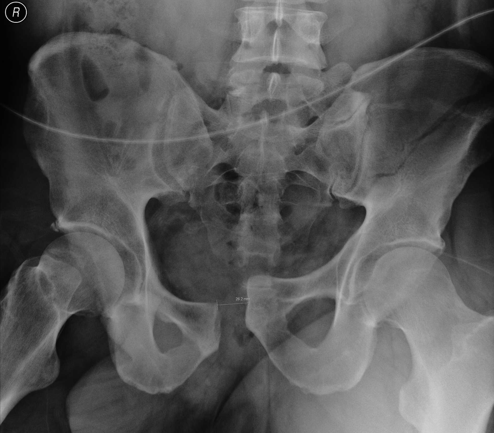 Pelvic Fracture APC 2